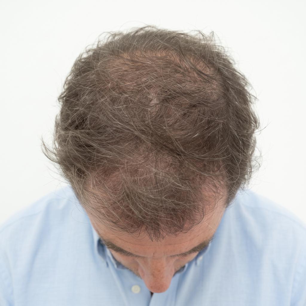 Paciente después de su tratamiento en Novo Hair