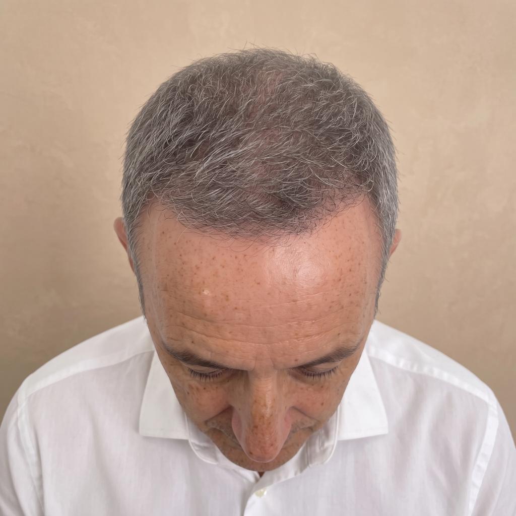 Paciente después de su tratamiento en Novo Hair