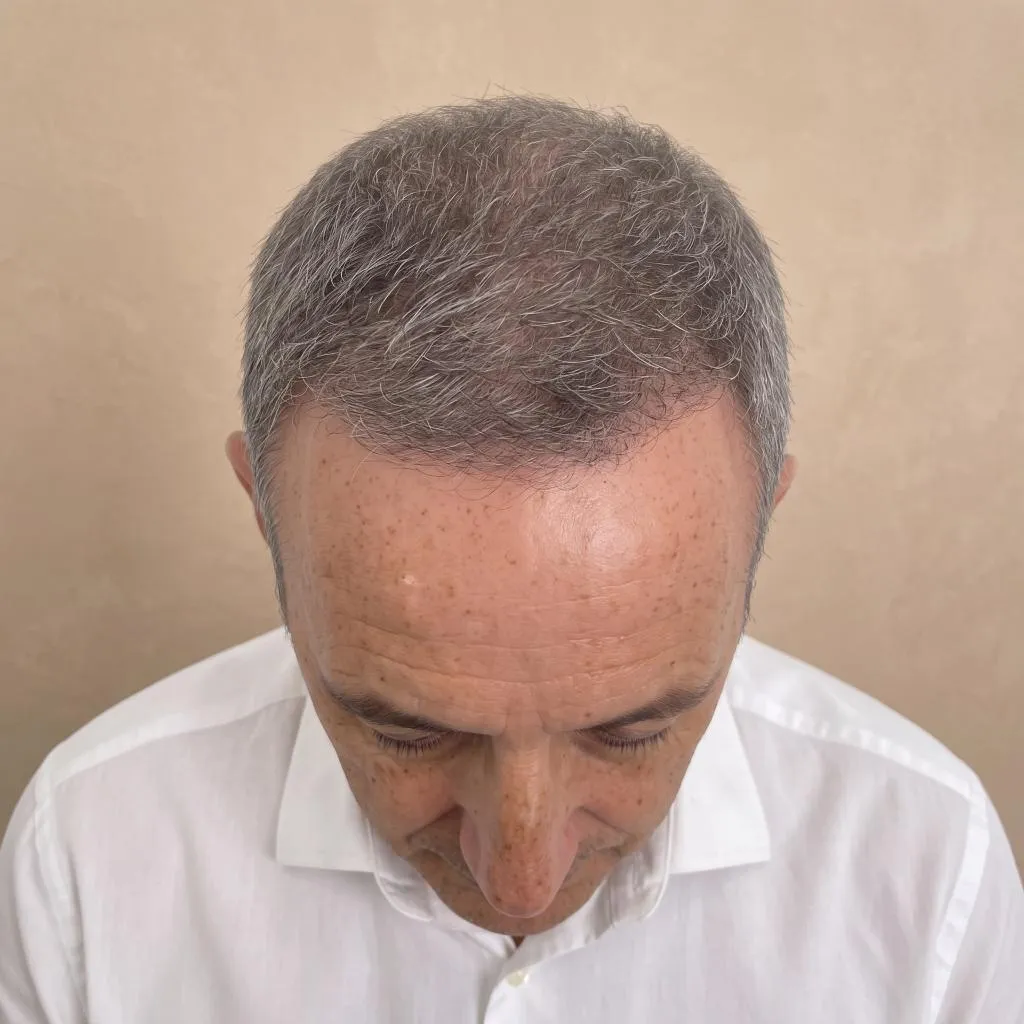 Paciente después de su tratamiento en Novo Hair