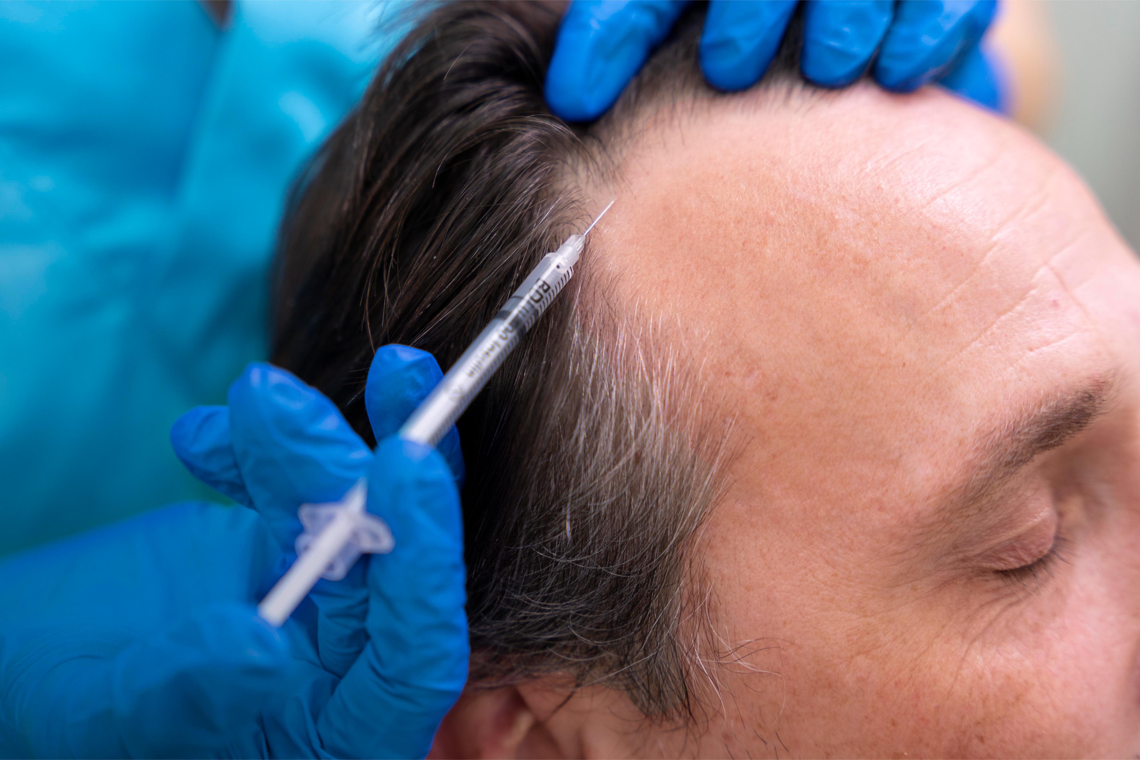 Tratamiento de biorrevitalización capilar en Novo Hair
