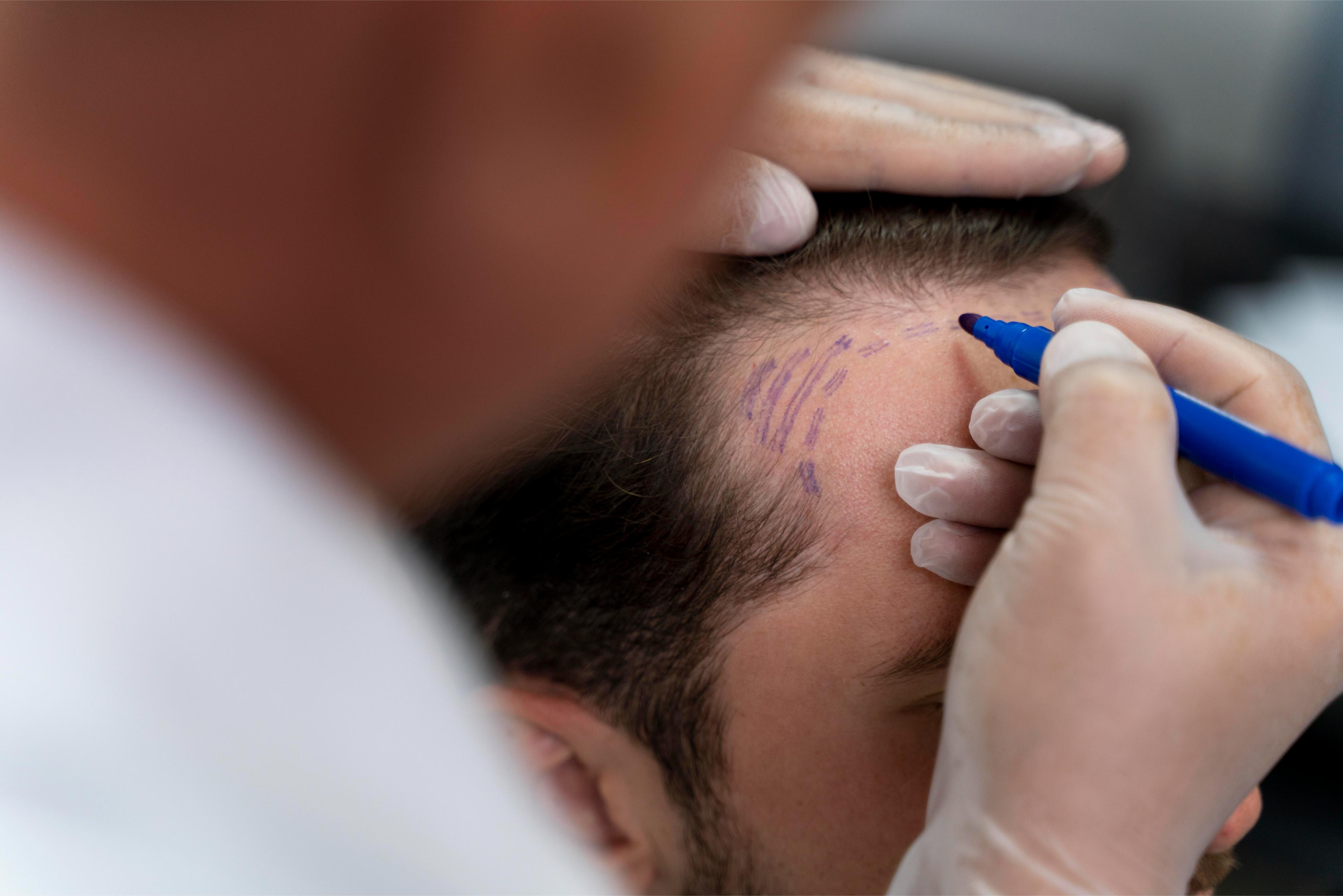 Implante capilar FUE Zafiro en Novo Hair