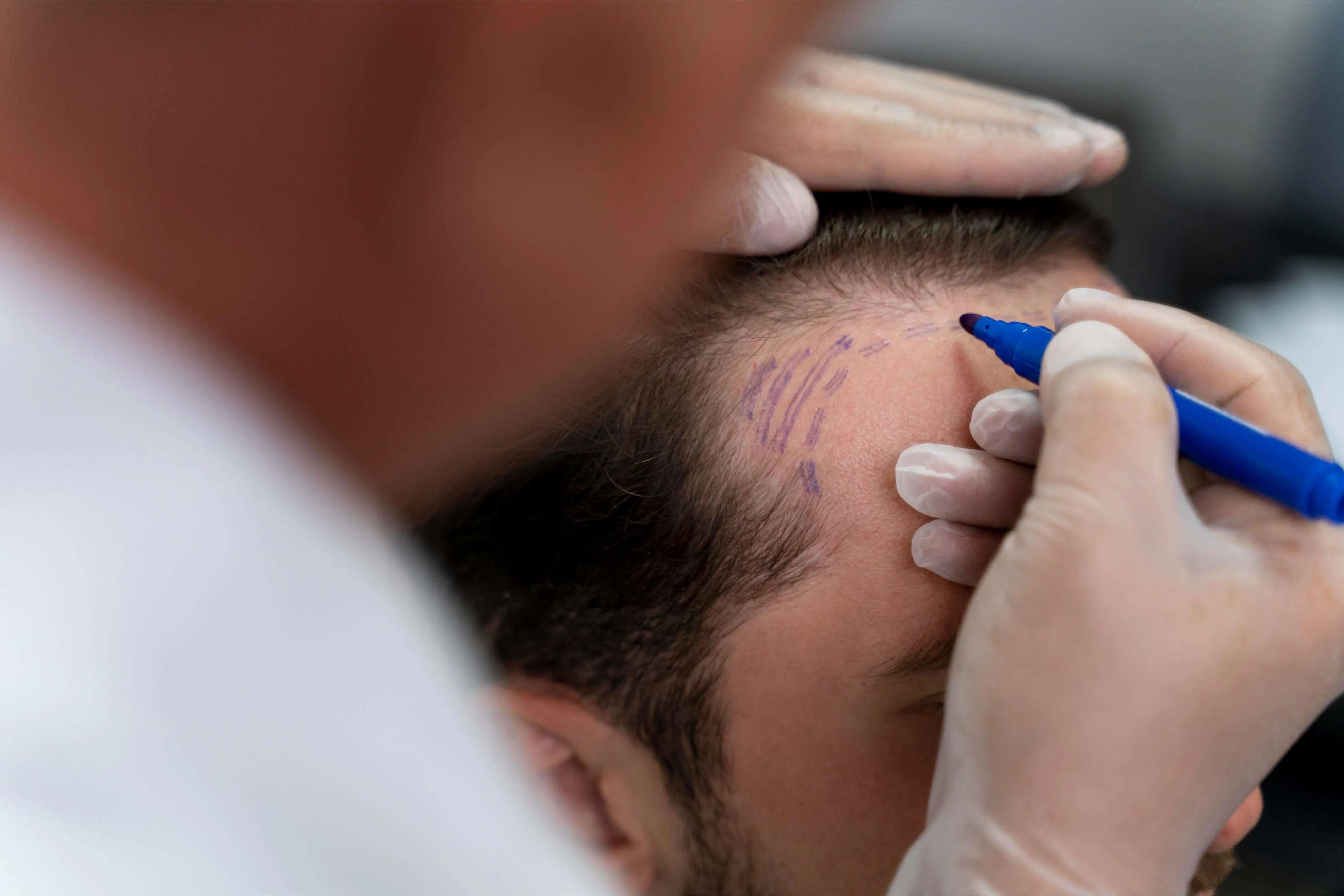 Implante capilar FUE Zafiro en Novo Hair
